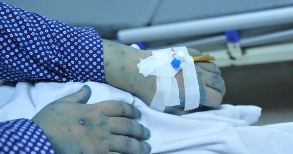 Nhiều bệnh nhân thủy đậu và ho gà nhập viện vì biến chứng