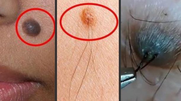 Nốt ruồi cũng có nguy cơ gây ung thư da?