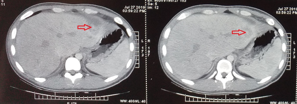 Hình ảnh dị vật đâm xuyên qua vùng gan trái trên phim CT scan bụng.