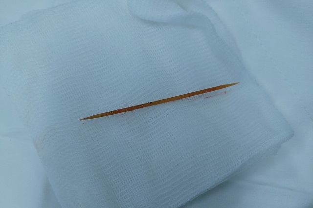 Tăm tre dài 80 mm được lấy ra sau phẫu thuật.