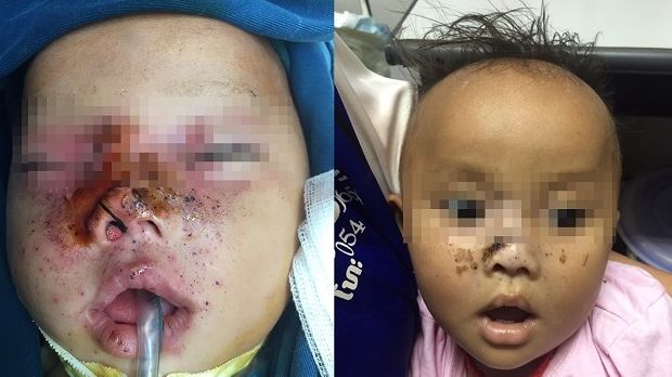 Bé trai 9 tháng tuổi bị súng kíp cướp cò bắn thẳng vào mặt