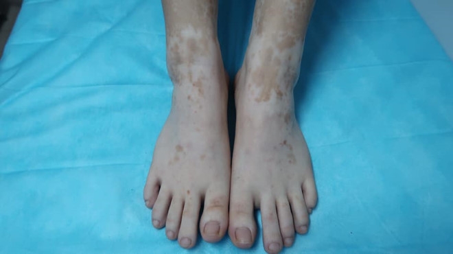 Hình ảnh tổn thương da chân của nữ bệnh nhân sử dụng lá trầu không ngâm chân. (Ảnh: Bác sĩ cung cấp)