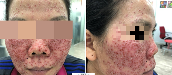 Một bệnh nhân sau khi lột da mặt bằng vi tảo biển đã bị nổi mụn nước, mụn mủ và phải đến điều trị tại bệnh viện Da Liễu TP Hồ Chí Minh. Ảnh BV cung cấp