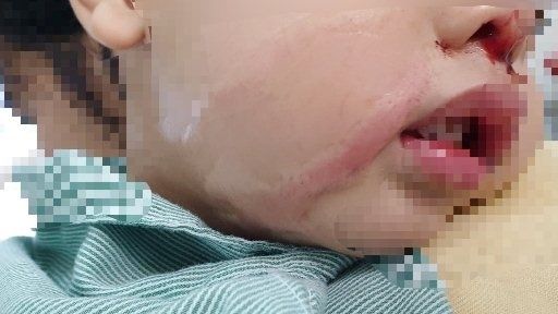 Bị nhỏ nhầm axit vào mũi, bé trai hai tuổi bỏng nặng