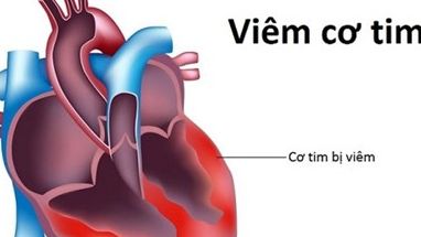 Viêm cơ tim: Dấu hiệu nào cảnh báo nguy hiểm?