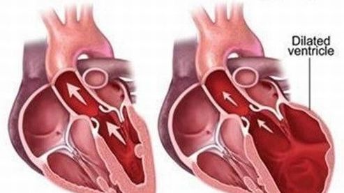 Thông tin chính thức về hai trường hợp tử vong do viêm cơ tim