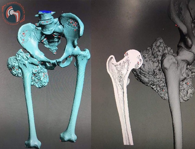 Quá trình tạo ra mô hình in 3D từ bản quét cắt lớp vi tính của bệnh nhân.