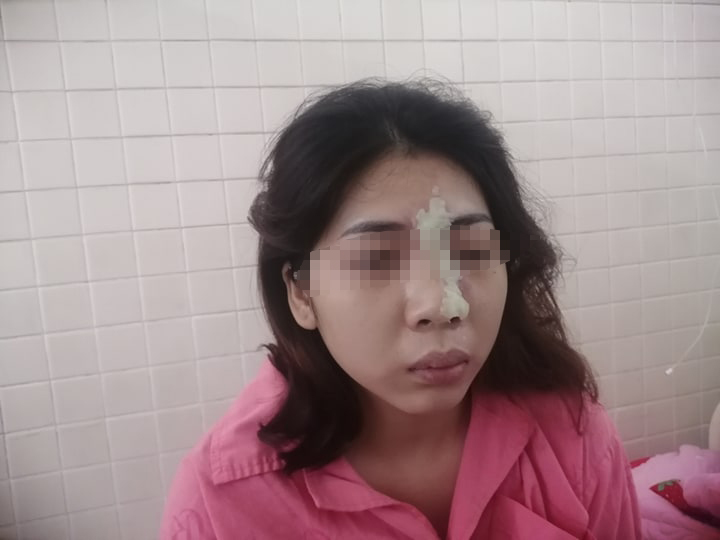 Nữ bệnh nhân bị mù mắt sau khi tiêm filler nâng mũi tại spa