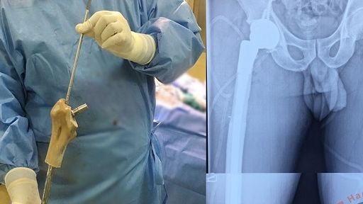 Lần đầu tiên, bác sĩ Việt Nam ghép xương đùi nhân tạo in 3D