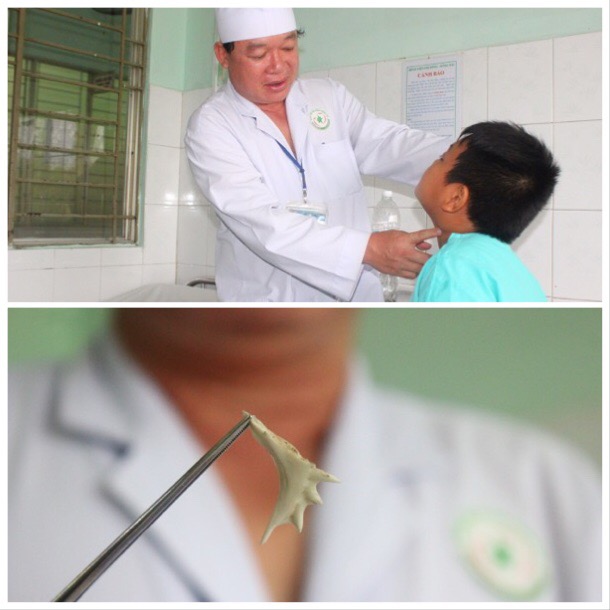 Bác sĩ Ngô Văn Phan thăm khám cho bệnh nhân chiều 5-11. Ảnh dưới: Hình thù chiếc xương cá bị bệnh nhân nuốt phải.