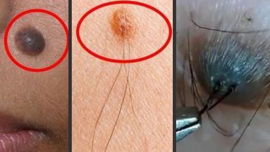 Nốt ruồi nào sẽ có nguy cơ gây ung thư da?