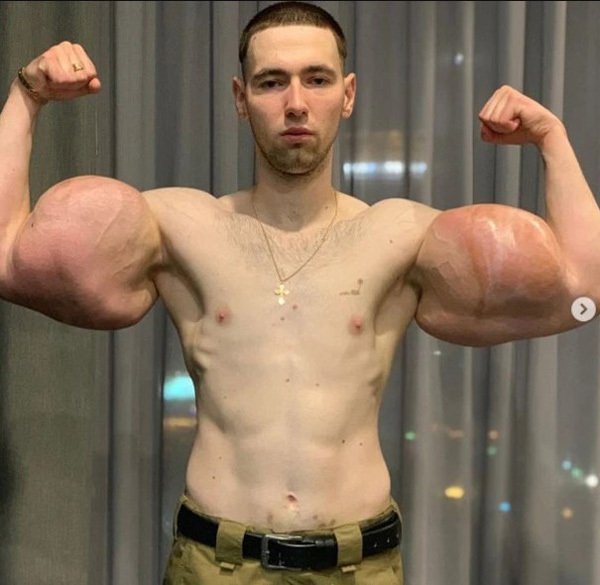 Kirill bơm chất tăng cơ bắp bất chấp nó không ăn nhập với thân hình gầy của anh.