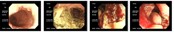 Hình ảnh nội soi đại trực tràng của bệnh nhân phát hiện khối u trong lòng đại tràng