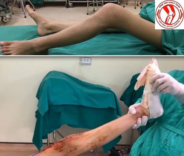 Chân của nữ sinh Trúc U 16 tuổi trước (trên) và sau (dưới) phẫu thuật ở tư thế duỗi tối đa.