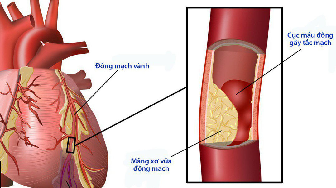 Cách ngừa biến chứng tim mạch cho người đái tháo đường