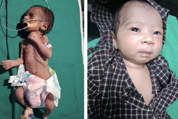 Bé gái sinh non đã hồi phục diệu kỳ sau hơn 1,5 tháng điều trị tích cực trong bệnh viện