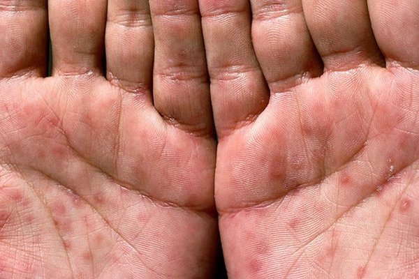 Trong giai đoạn thứ hai của bệnh, ban đỏ xuất hiện trên bất kỳ vùng nào trên cơ thể, trong đó có lòng bàn tay, bàn chân.
