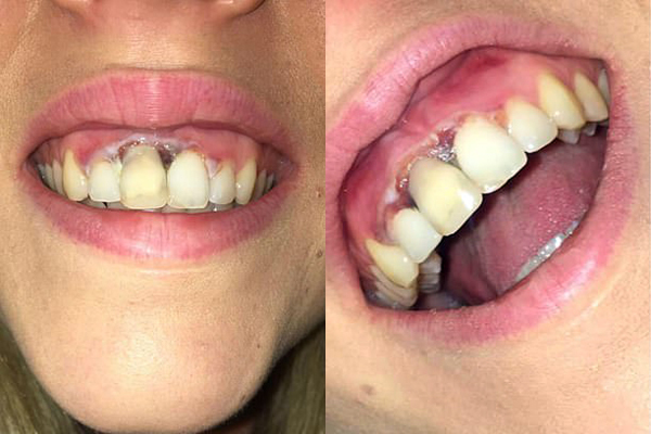 Phần lợi xung quanh 4 răng cửa của Wills chuyển đen kèm đau đớn sau khi tẩy trắng răng