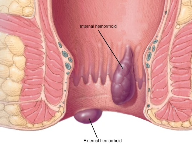 Bệnh trĩ gồm trĩ nội và trĩ ngoại, một số trường hợp kết hợp cả trĩ nội và trĩ ngoại.