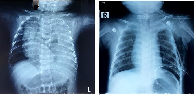 Ảnh X-quang bên phải cho thấy phổi nở đều bình thường sau khi được thắt ống ngực so với lúc đầu (ảnh trái). Ảnh:BSCC