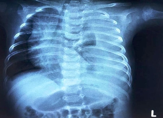 Phim X-quang cho thấy phổi bệnh nhi bị chèn ép do tràn dịch dưỡng chấp. Ảnh: BSCC