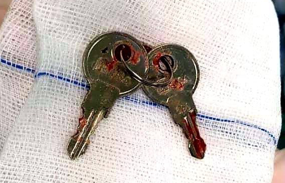 Chùm chìa khóa được đưa ra khỏi dạ dày bệnh nhi. Ảnh do bệnh viện cung cấp.