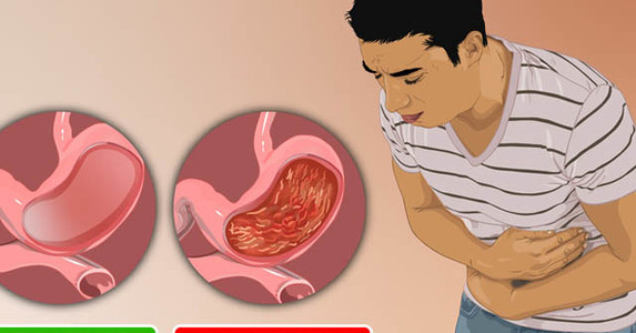 12 triệu chứng bạn đã mắc bệnh viêm dạ dày mà không hay biết