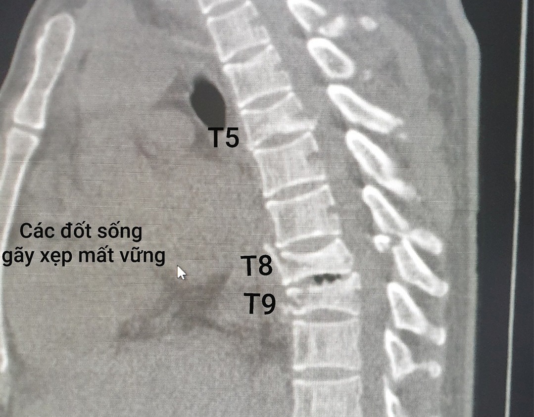 Ảnh chụp CT cho thấy vùng chấn thương cột sống ngực của bệnh nhân. Ảnh: BSCC