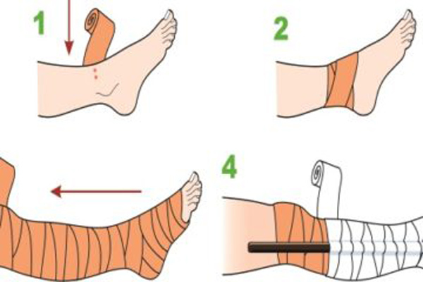 Khi bị rắn cắn, cách sơ cứu đúng cách là nẹp bất động tay, chân khi của bệnh nhân rồi chuyển đến cơ sở y tế đủ trang thiết bị để cấp cứu