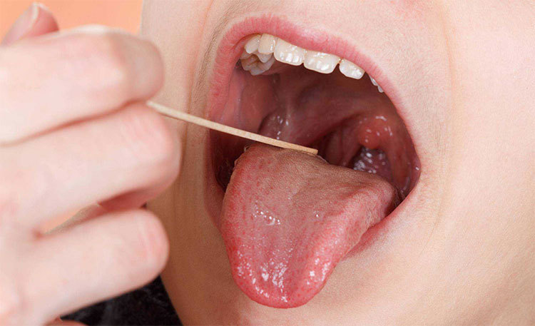 Ung thư lưỡi ngày càng phổ biến, nguyên nhân từ đâu?