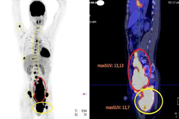 Hình ảnh PET/CT cho thấy bệnh nhân có nhiều hạch khắp cơ thể, các hạch tăng hấp thu FDG (vòng tròn màu đỏ), các tổn thương xương tăng hấp thu FDG (vòng tròn màu vàng)