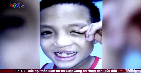 Phương pháp phẫu thuật mới cải thiện phát âm cho trẻ sứt môi, hở hàm ếch