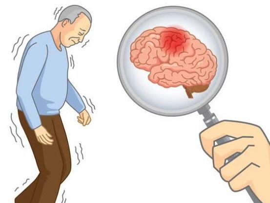 3 đặc điểm xuất hiện khi thức dậy vào buổi sáng cảnh báo bệnh nhồi máu não