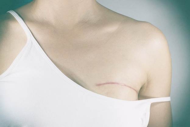 Vết mổ cần được chăm sóc kỹ lưỡng.