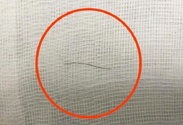 Mảnh thép rây lọc cháo dài 2cm được lấy ra từ thành họng cháu bé - Ảnh: BSCC