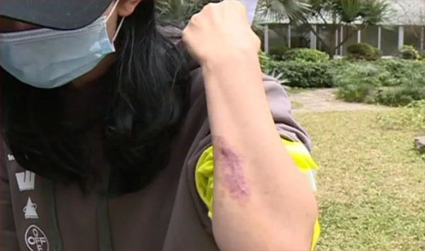 Không chỉ hoại tử ngực, chị Vương còn bị một vết sẹo dài trên tay do bất cẩn khi phẫu thuật