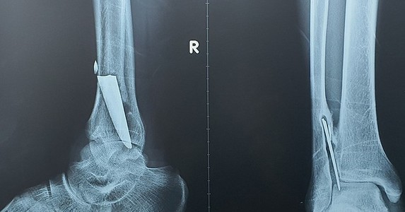 Lưỡi dao bị 'bỏ quên' 3 năm trong cổ chân
