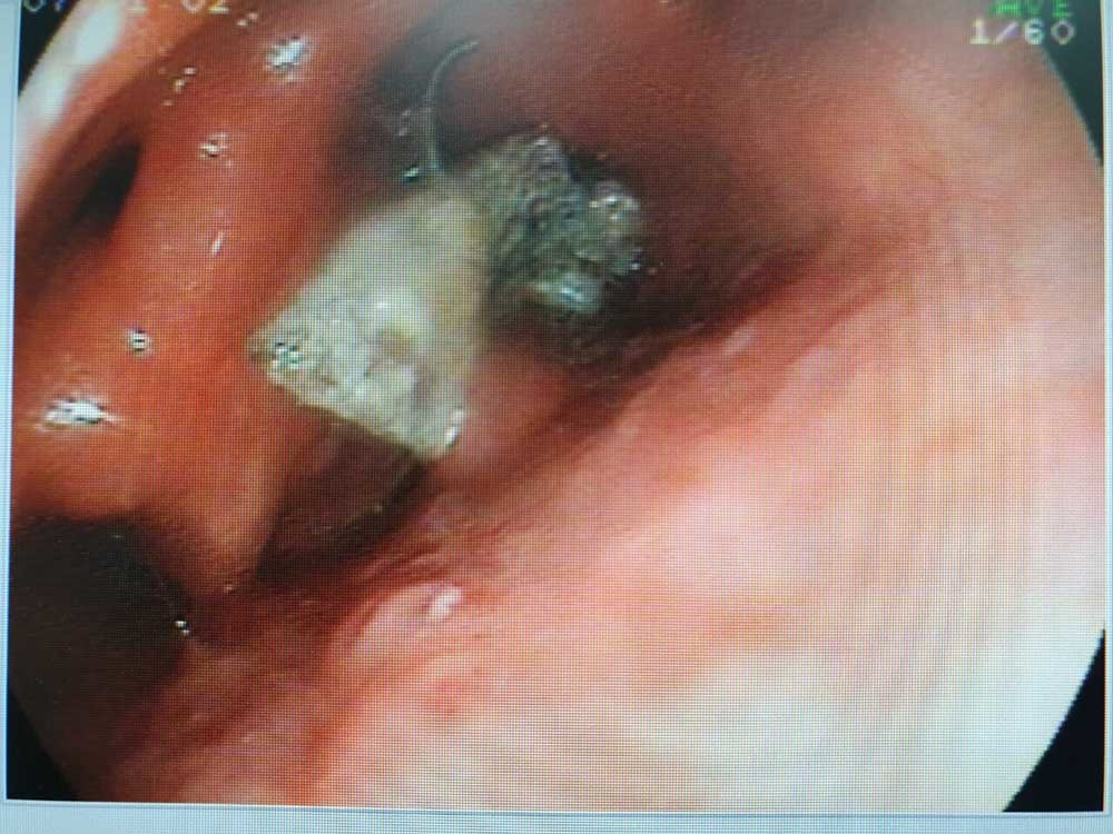 Hình ảnh nội soi cho thấy, hàm răng giả 2 móc sắt cắm vào chỗ nối giữa hầu họng và thực quản của bệnh nhân