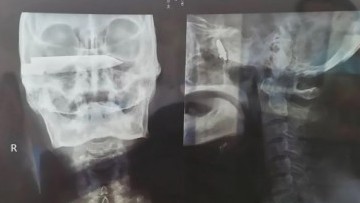 Phẫu thuật lấy dao dài 10cm kẹt trong đầu bệnh nhân suốt 26 năm