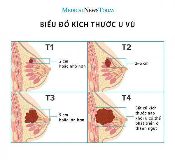 Khối u nguyên phát được đo ở điểm rộng nhất và tính theo đơn vị cm hoặc mm. Ảnh: Medical News Today