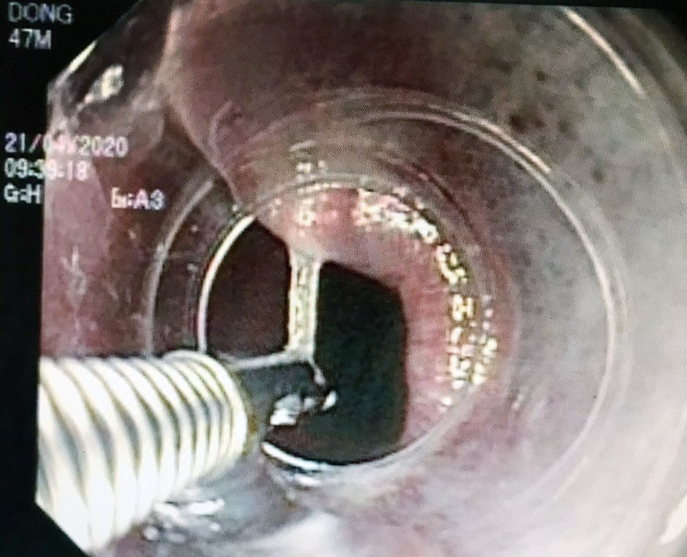 Hình ảnh X-quang cho thấy mảnh xương cá cắm sâu vào thực quản bệnh nhân. Ảnh: Bệnh viện cung cấp