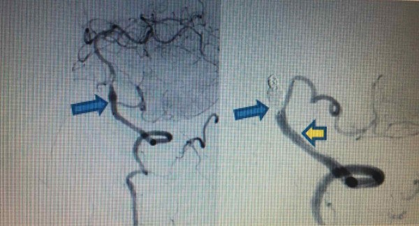 Hình ảnh trước và sau can thiệp (trái: Phình hình thoi bóc tách động mạch) và
(phải: Đặt stent động mạch đốt sống - PICA trái và bít coils tắc hoàn toàn phình hình thoi)