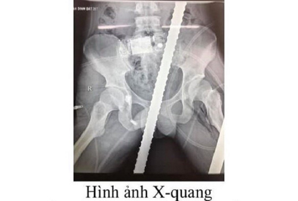 Hình ảnh phim chụp X quang của bệnh nhân