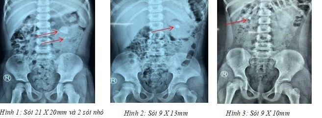 Ảnh chụp X-quang cho thấy các viên sỏi thận của 3 bệnh nhi. Ảnh:BSCC