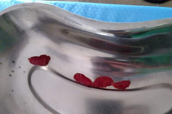 Sán lá gan trong dạ dày chị H. đã được gắp bỏ