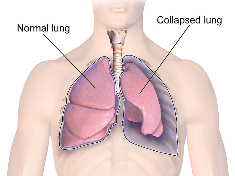 Lá phổi bình thường (trái) và lá phổi bị xẹp do tràn khí màng phổi (phải). Minh họa: wikiland.