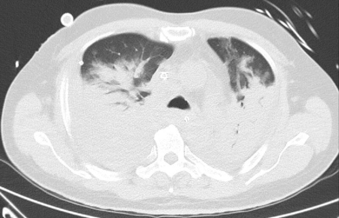 Hình ảnh scan cho thấy phổi của ông Toh bị viêm và tràn dịch với các đốm trắng. Ảnh: National University Heart Centre