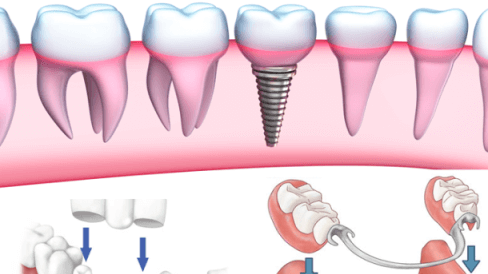 Điều trị mới trong việc chữa sâu răng