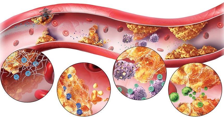 Rối loạn Lipid máu - Ảnh minh họa