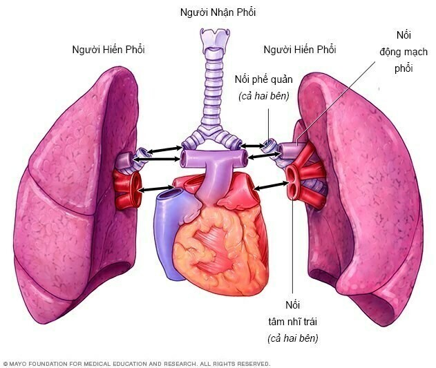 5 câu hỏi trước mỗi ca ghép phổi